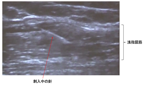 超音波ガイド下の施注