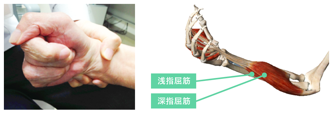 図1．手指屈曲の主な関与筋
